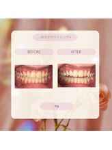 プラスビー 2号店(+b)/ホワイトニングビフォーアフター