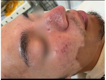 サロンドエクラ 南堀江(salon de eclat)の写真/【メンズ限定】初対面で差がつく肌へ/毛穴黒ずみ徹底洗浄＋最新AI肌質診断★お仕事帰りOK