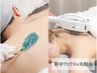 【女性/薄着の季節になる前に】背中ワックス×光脱毛　￥11,000→¥7.000