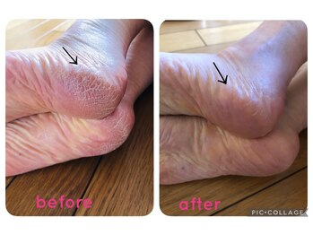 ビューティースパ/かかとのガサガサ塗るだけのケア