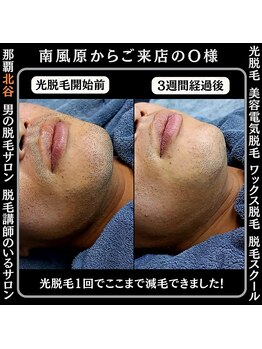 ディースタイル 北谷店(Dstyle)/北谷メンズ脱毛ヒゲBefore after
