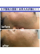 クラリ(Clari)/ヒゲ脱毛/脱毛/メンズ脱毛