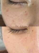 ビーグロウ(be Grow)/タイムロックでシミケアも☆