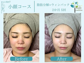 ボディコンディション/小顔/痩身/ウィンバック毛穴洗浄
