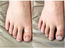 アーティネイルズ(Aaty Nails)/【深爪矯正】フット
