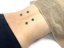 安心堂幕張接骨院 鍼灸院/お灸