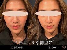 チョコバリ 恵比寿店(chocobari)/小顔リフトアップ（美容鍼）20代