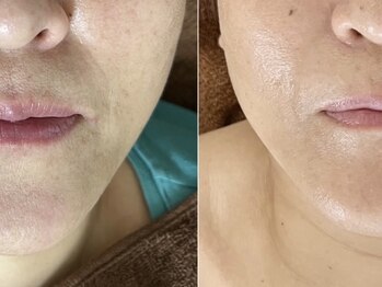 エフプラネット(F Planet)/エイジレスフェイシャル