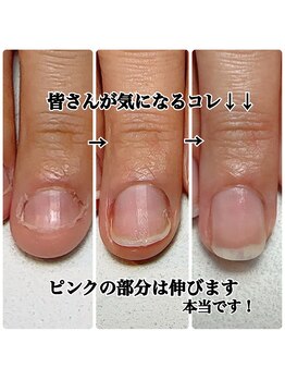 深爪が伸びる！感動！