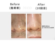 アブニールブリヨン/ハーブピーリング　Before After