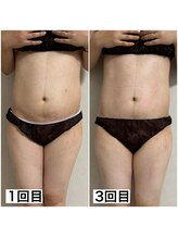 ミュウ(miuex)/産後痩身3回目