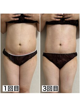 ミュウ(miuex)/産後痩身3回目