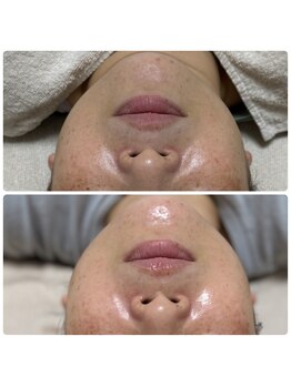 サラン(SALON)/お顔 ビフォー アフター