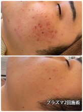 アースコアフュールボーテ ひたち野うしく店(EARTH coiffure beaute)/プラズマシャワー