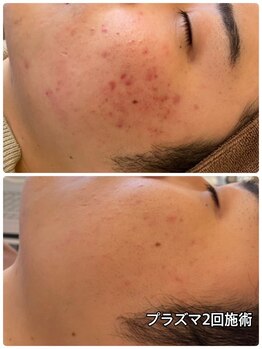 アースコアフュールボーテ ひたち野うしく店(EARTH coiffure beaute)/プラズマシャワー