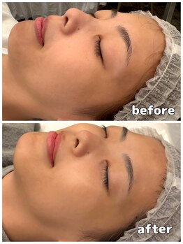 アモ(amo)/アンストレス1回施術後☆