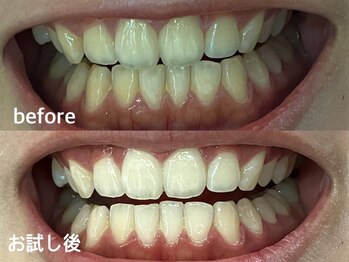 グラーティア 梅田店(gratia)/ホワイトニング★お試し後★