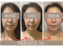 ドクターボディ 恵比寿店(Dr.Body)/【たるみ糸リフト級小顔 50代】