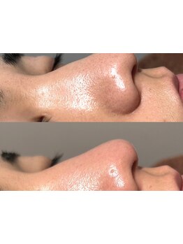 毛穴ケアをしたい