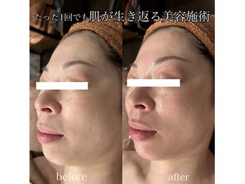 マージェ(magie)/プラズマフェイシャル