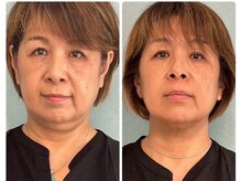 テルケル 佐賀/