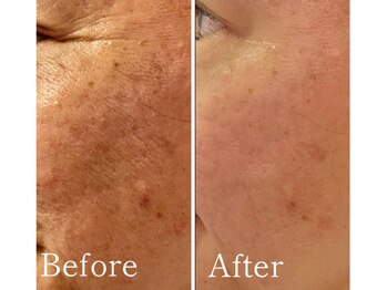 MMK/しわケアにもたるみケアにも◎