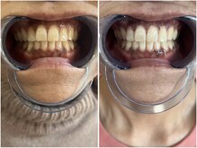 レイズ(RAISE)/セルフホワイトニング