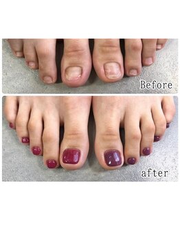 ティアラネイル 宇都宮/深爪矯正