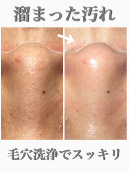アウラ(Aula)/毛穴の汚れスッキリ！