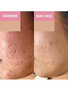 リシェル(Richelle)/ 【GREENPEELセンシダーム】