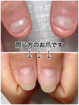 スマイルニコ(smile nico)/深爪矯正　1年後