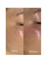 アイラ 大宮西口店(EYELA)/フェイシャルwax脱毛