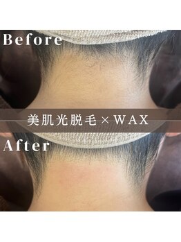 エピナ 横浜店(Epina)/うなじ脱毛/ブライダル脱毛