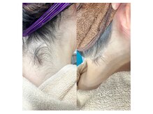 ミャオの雰囲気（大人気！うなじ脱毛ですっきり長い首を！うなじ美人に♪）