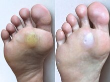 ルーム ノヘア(Room nohea)の雰囲気（硬い角質も魚の目もまとめてお手入れ【角質ケア¥8,300～】）