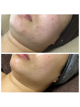 リラーナ(Re rana)/肌荒れ