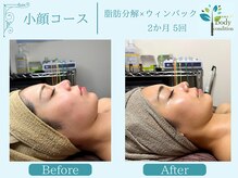 ボディコンディション/小顔/痩身/ウィンバック毛穴洗浄