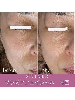 ステラティエ(Stellatier)/シミ/シワ/たるみ/リフトアップ