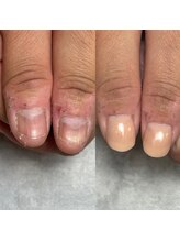 トレフル(Trefle)/深爪の見た目が1回で変わります