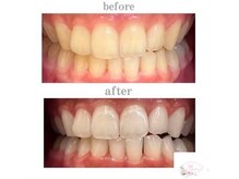 ホワイトニングショップ 本厚木店/【ビフォーアフター】10回