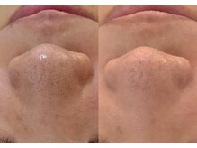 ルミエール シーサイド(L’MIERE seaside)/鼻の黒ずみ改善