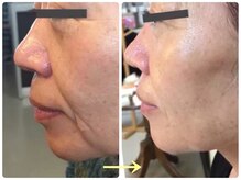 リファイン(REFINE)/細胞活性！若肌へ・・・リフトUP