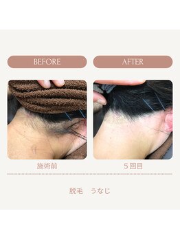 ミスミセス(Miss.Mrs)/うなじ脱毛メニュー