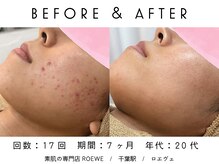 ロエヴェ(ROEWE)/ニキビ改善・毛穴ケア・肌質改善