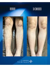 ルミーク(Lumique)/ひざ下1０回目 症例 H様