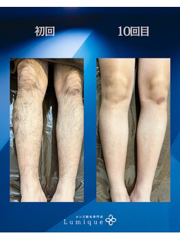 ルミーク(Lumique)/ひざ下1０回目 症例 H様