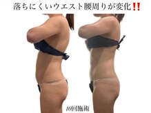 痩身革命 大宮店/3ヶ月8回の施術でこの変化♪