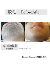 エミルカ(EMILUCA)/メンズ髭脱毛
