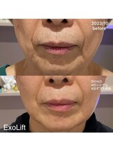 ルココン エミュ(le cocon e'mue)/ExoLift