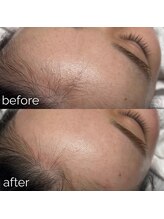 アリシア ビューティーサロン(Alicia)/肌が綺麗になるフェイスワックス